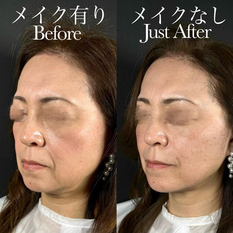 ヒアルロン酸8本 施術前と施術直後の斜め45度写真