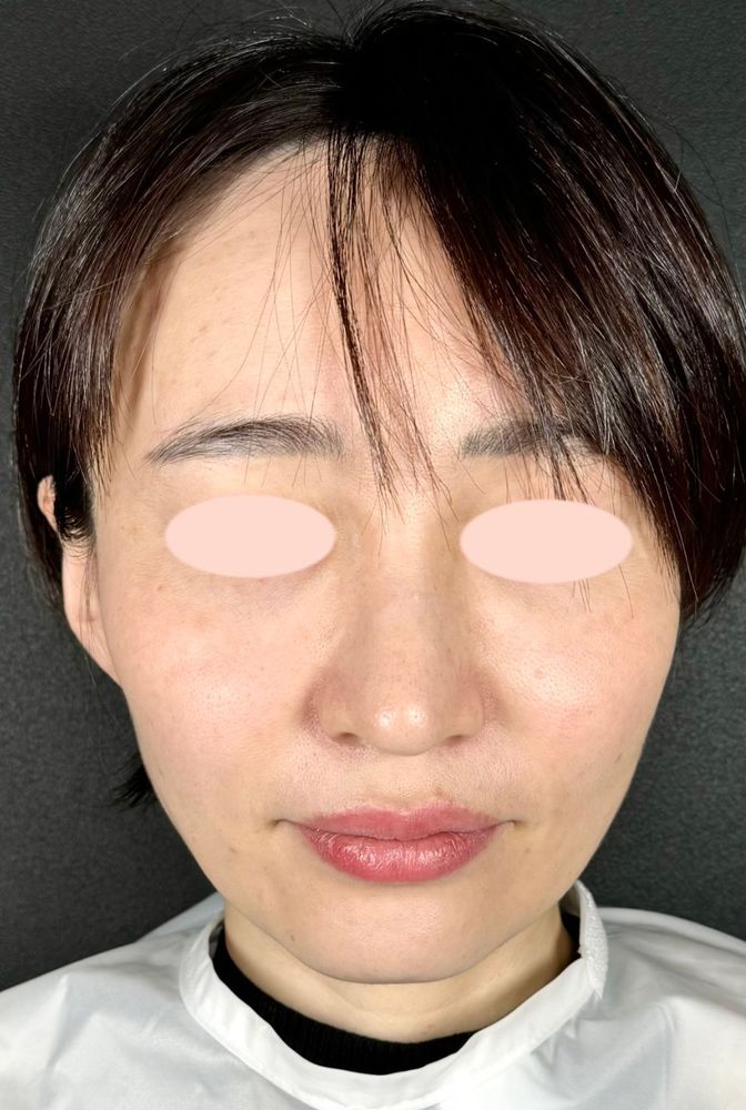 44歳 正面 術後2ヶ月