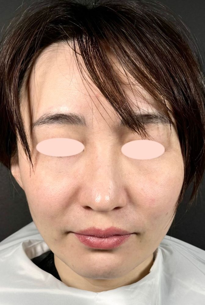 44歳 正面 施術前