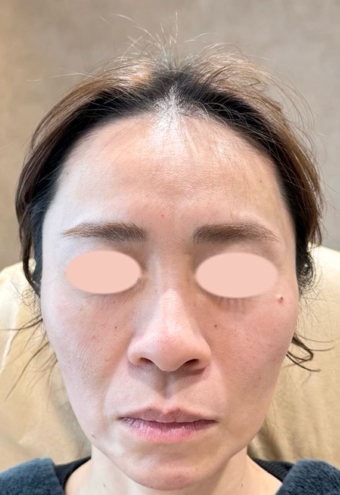 45歳 正面 施術直後