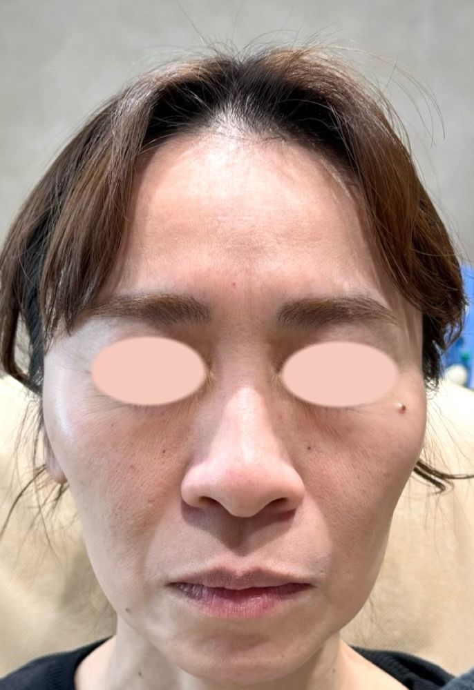 45歳 正面 施術前