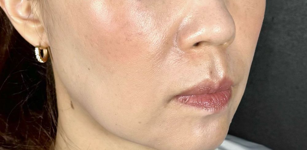 53歳 斜め 術後1ヶ月