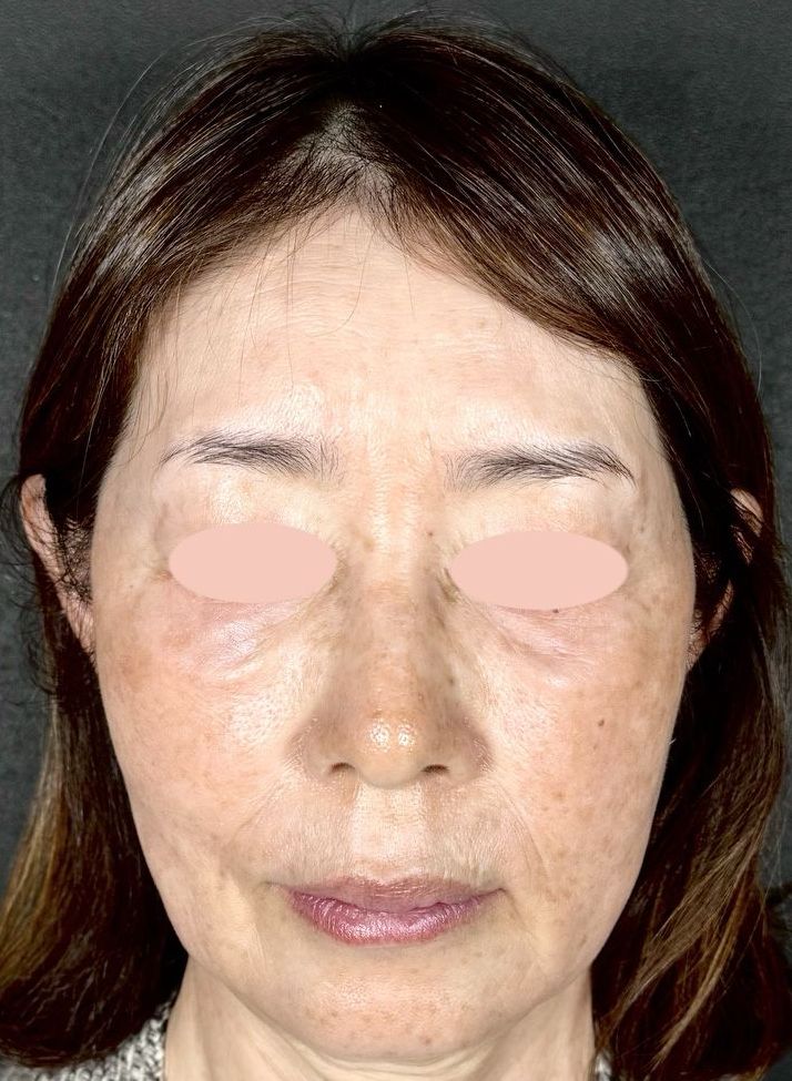 55歳 正面 術後5ヶ月