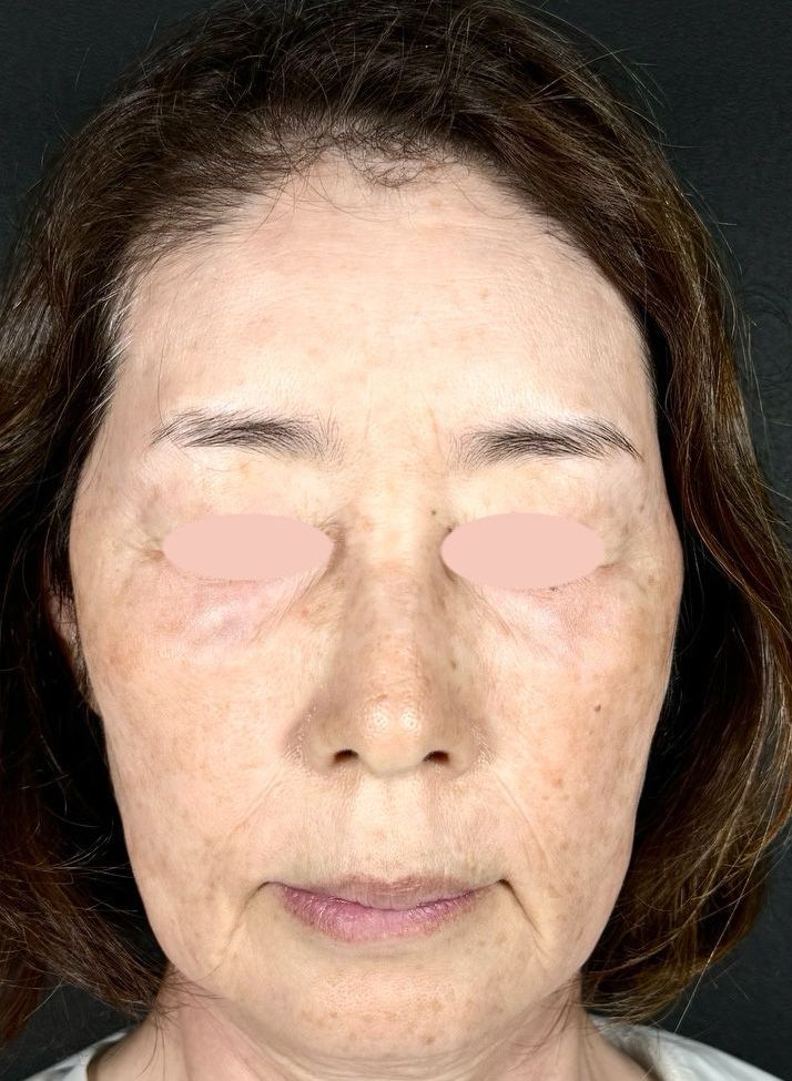 55歳 正面 施術前