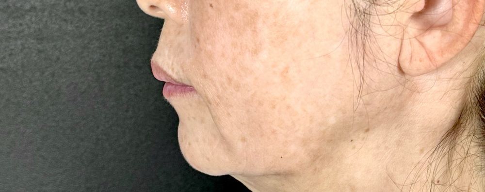 55歳 横顔 術後5ヶ月
