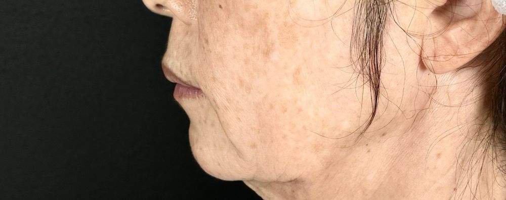 55歳 横顔 施術前