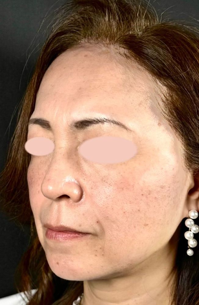 66歳 斜め 施術直後