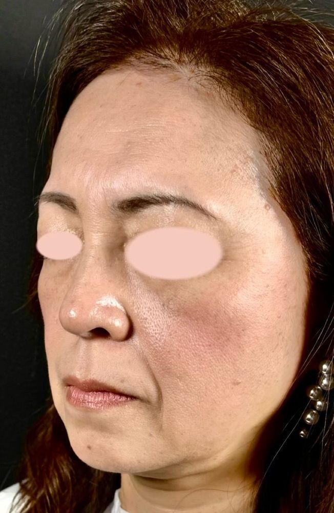 66歳 斜め 施術前